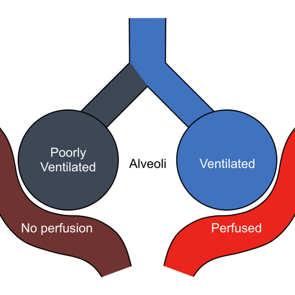File:Pulmonary shunt.png